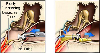 PE Tube Bypassing the Eustachian Tube